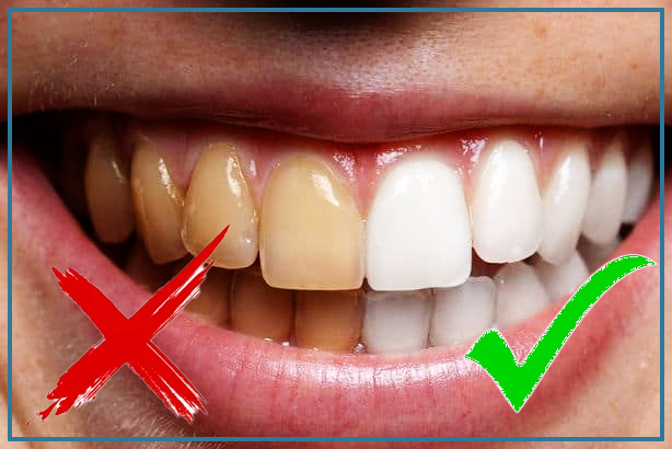 Here’s how to naturally remove coffee stains from your teeth?