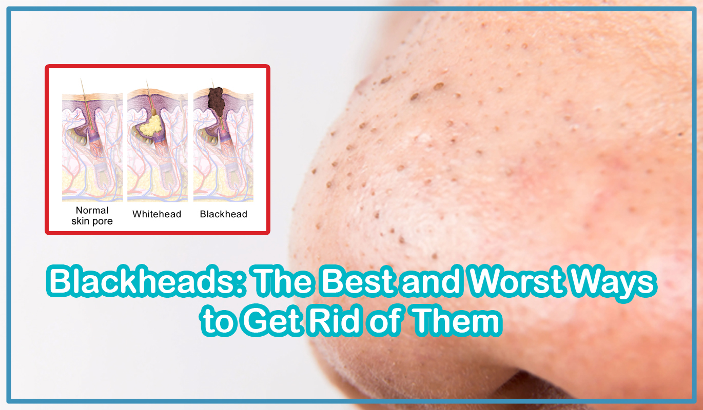 Blackheads: The Best and Worst Ways to Get Rid of Them