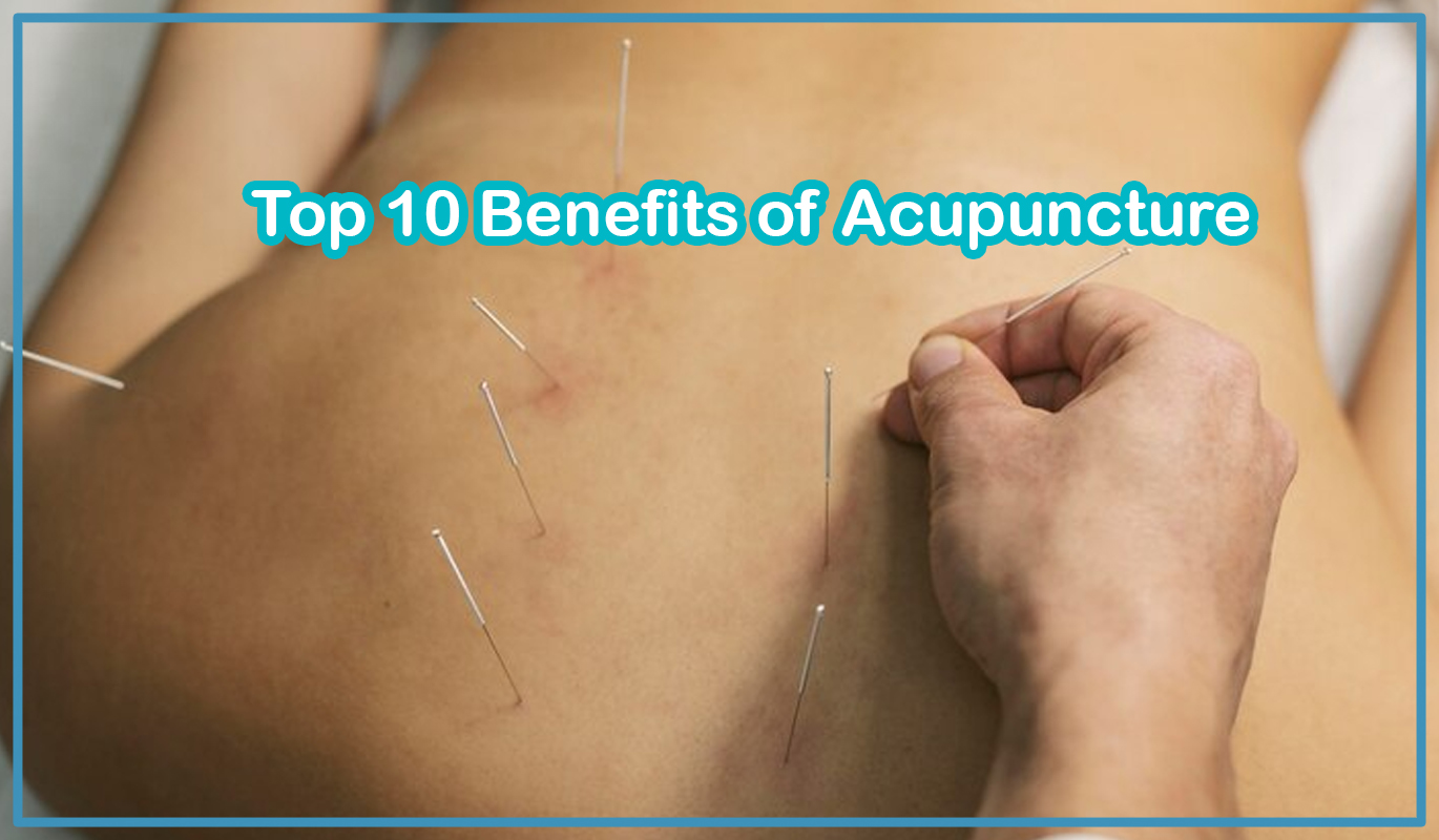 Top 10 Benefits of Acupuncture